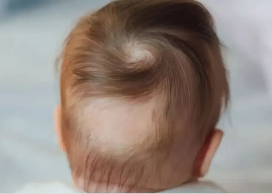 Child's hair being examined — hair loss in children