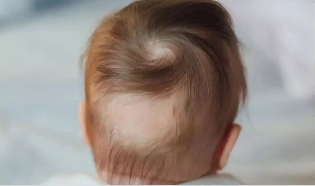 Child's hair being examined — hair loss in children