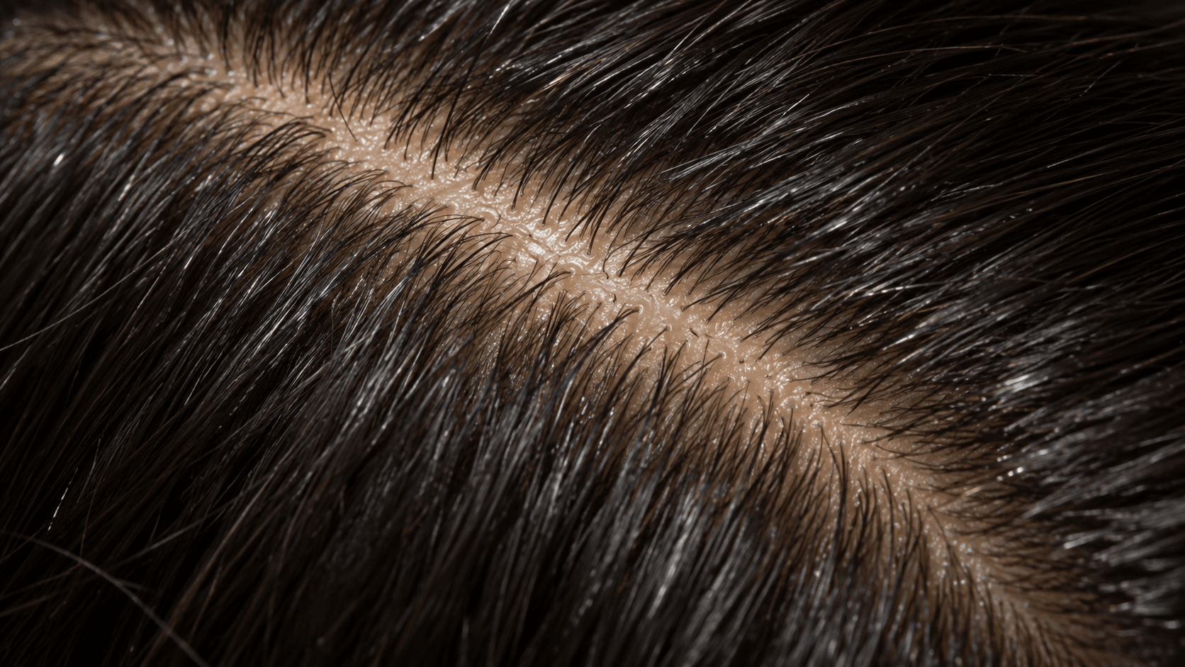 Oily scalp (seborrhoea): straight parting in dark hair with visible sebum shine and greasy roots