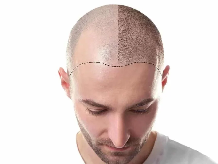 Scalp after a hair transplant — aftercare and long-term maintenance