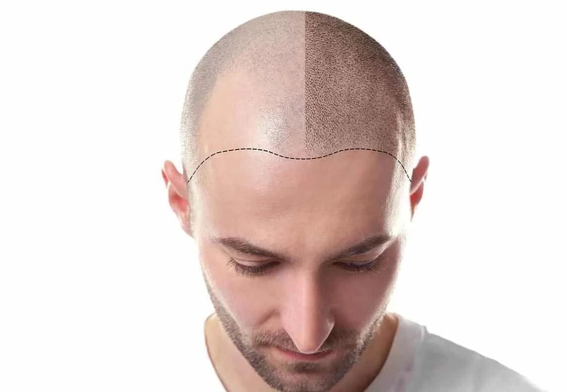 Scalp after a hair transplant — aftercare and long-term maintenance