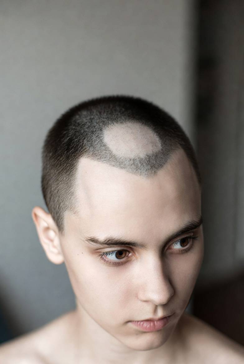 Alopecia areata patch on the scalp — care approaches