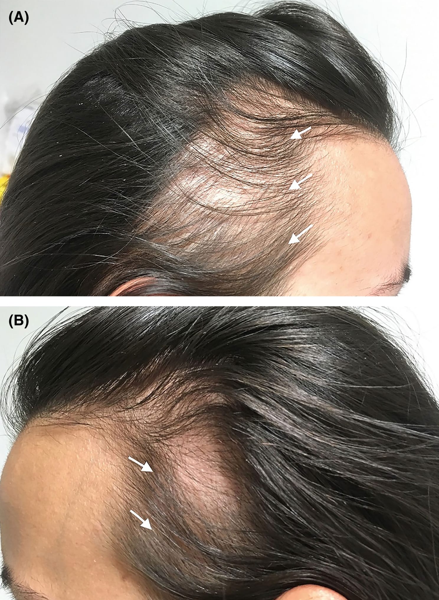 Traction alopecia affecting the frontal hairline and temples