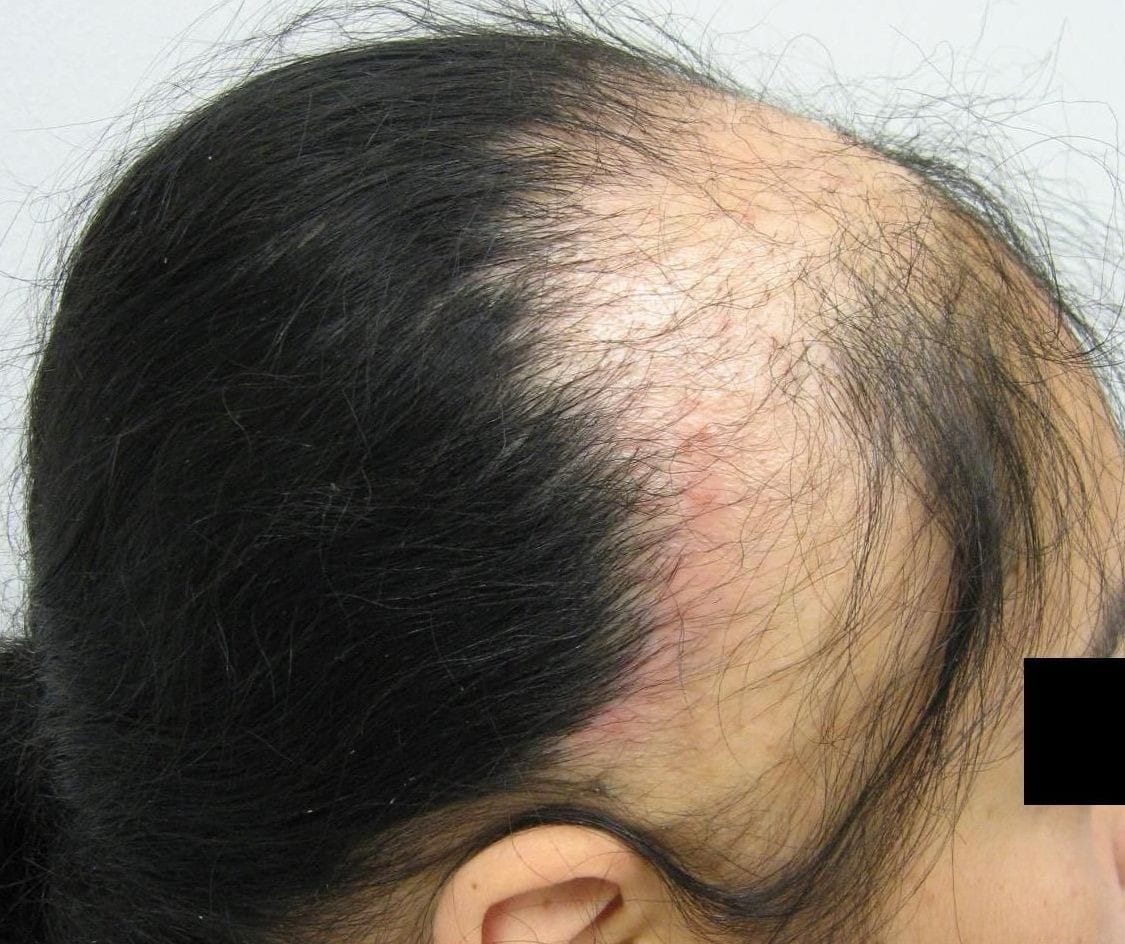 Clinical signs of traction alopecia with thinning at the edges