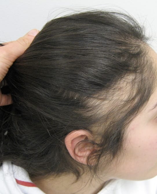 Fringe sign along the hairline — a typical sign of traction alopecia