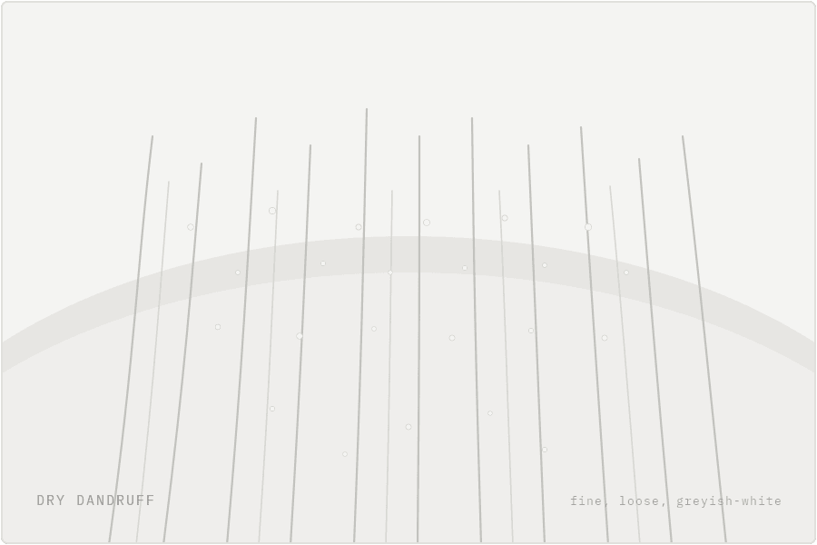 Dry dandruff illustration — fine greyish-white flakes on the scalp — SIMONE TRICHOLOGY