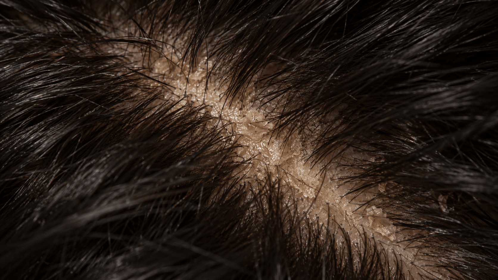 Oily dandruff: yellowish, greasy flakes stuck to a shiny scalp along a parting, close-up