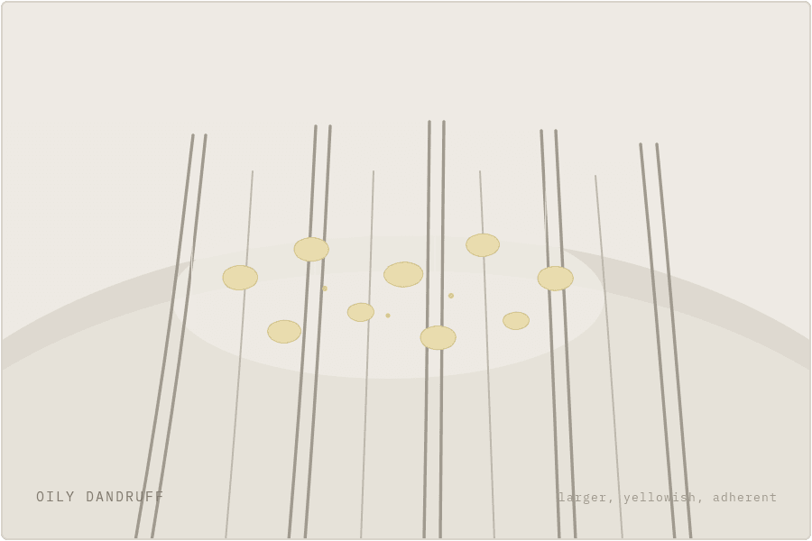 Oily dandruff illustration — larger yellowish adherent flakes on an oily scalp — SIMONE TRICHOLOGY