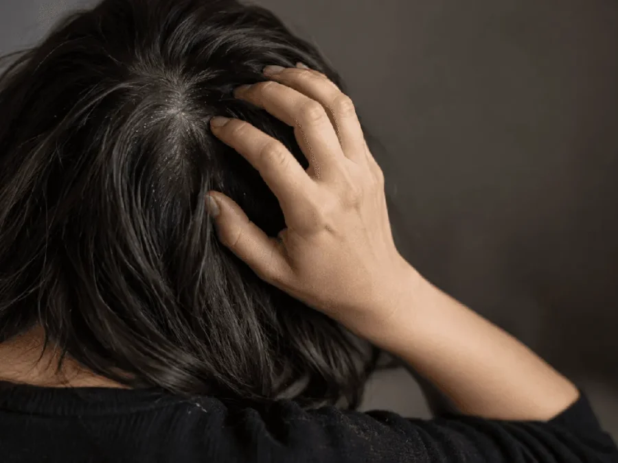 Itchy scalp and dandruff: woman pressing her fingertips into her crown, white flakes on the parting