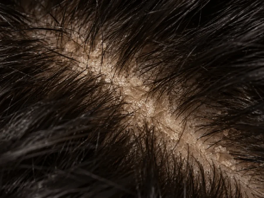 Oily dandruff: yellowish, greasy flakes stuck to a shiny scalp along a parting, close-up