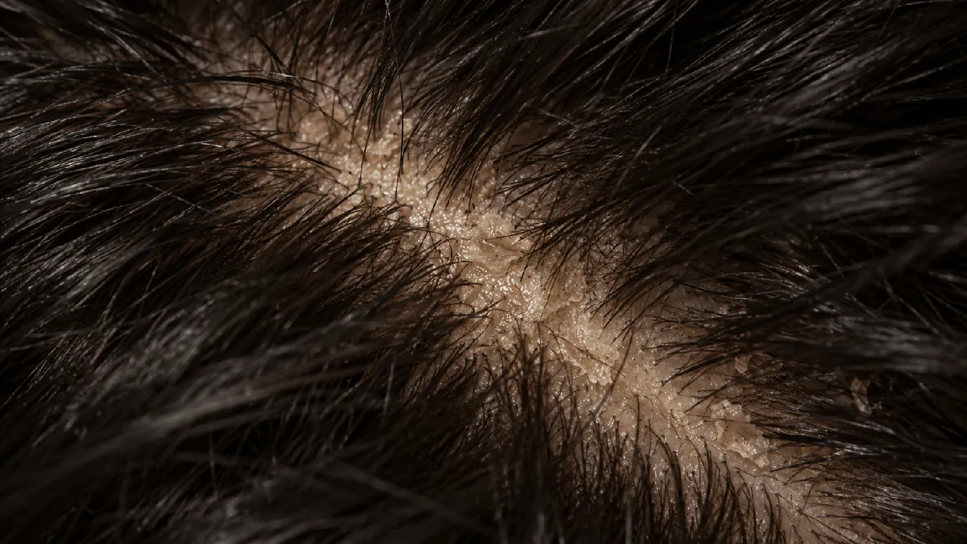 Oily dandruff: yellowish, greasy flakes stuck to a shiny scalp along a parting, close-up