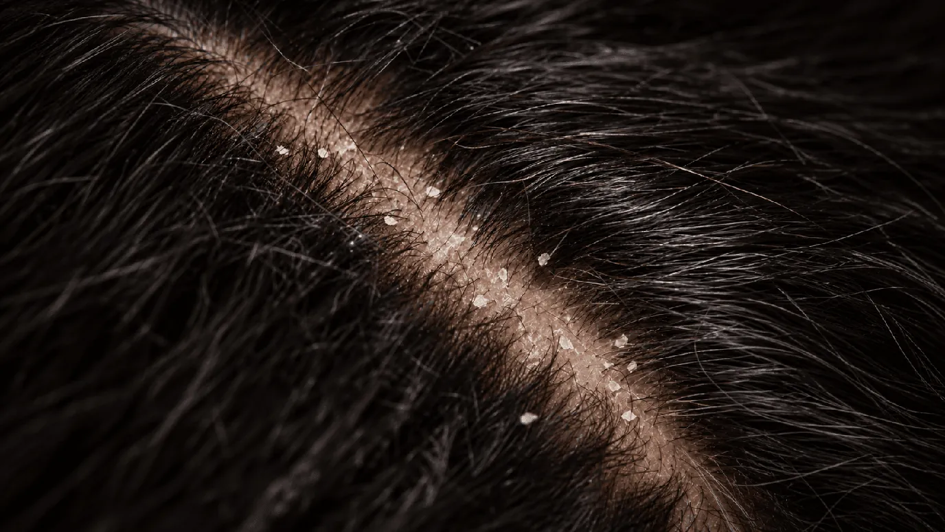 Dry dandruff: small white flakes along a diagonal parting on a dark-haired scalp, close-up