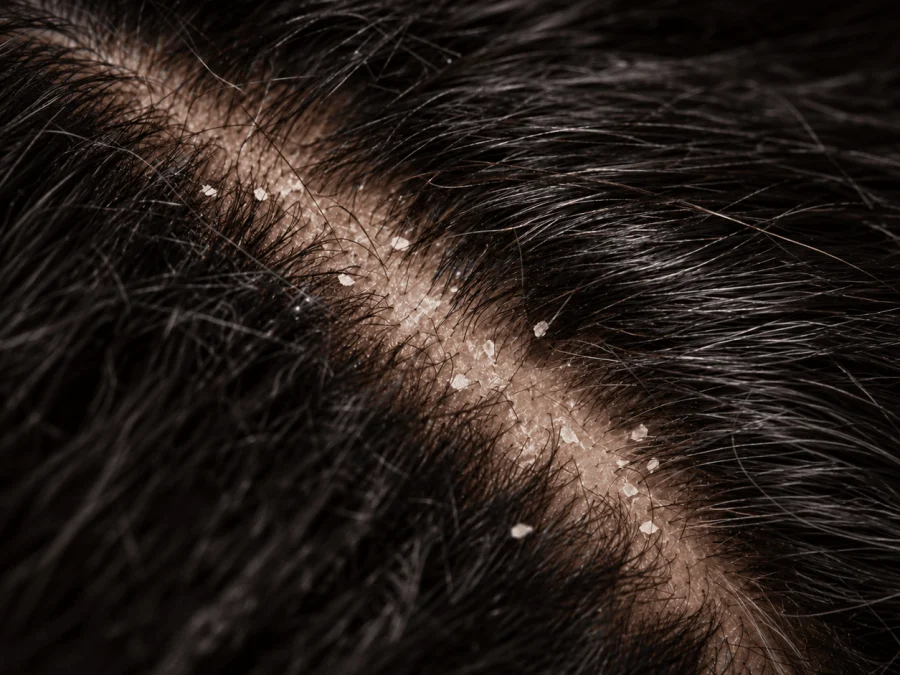 Dry dandruff: small white flakes along a diagonal parting on a dark-haired scalp, close-up