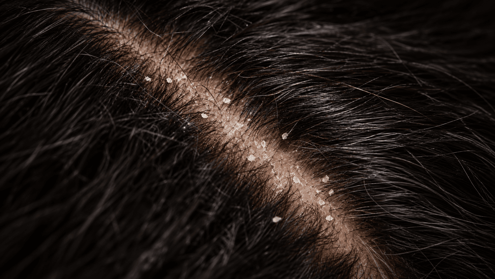 Dry dandruff: small white flakes along a diagonal parting on a dark-haired scalp, close-up